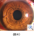 （図４）有水晶体眼内レンズ