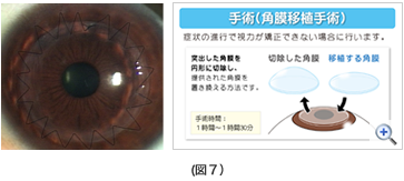 （図７）角膜移植 